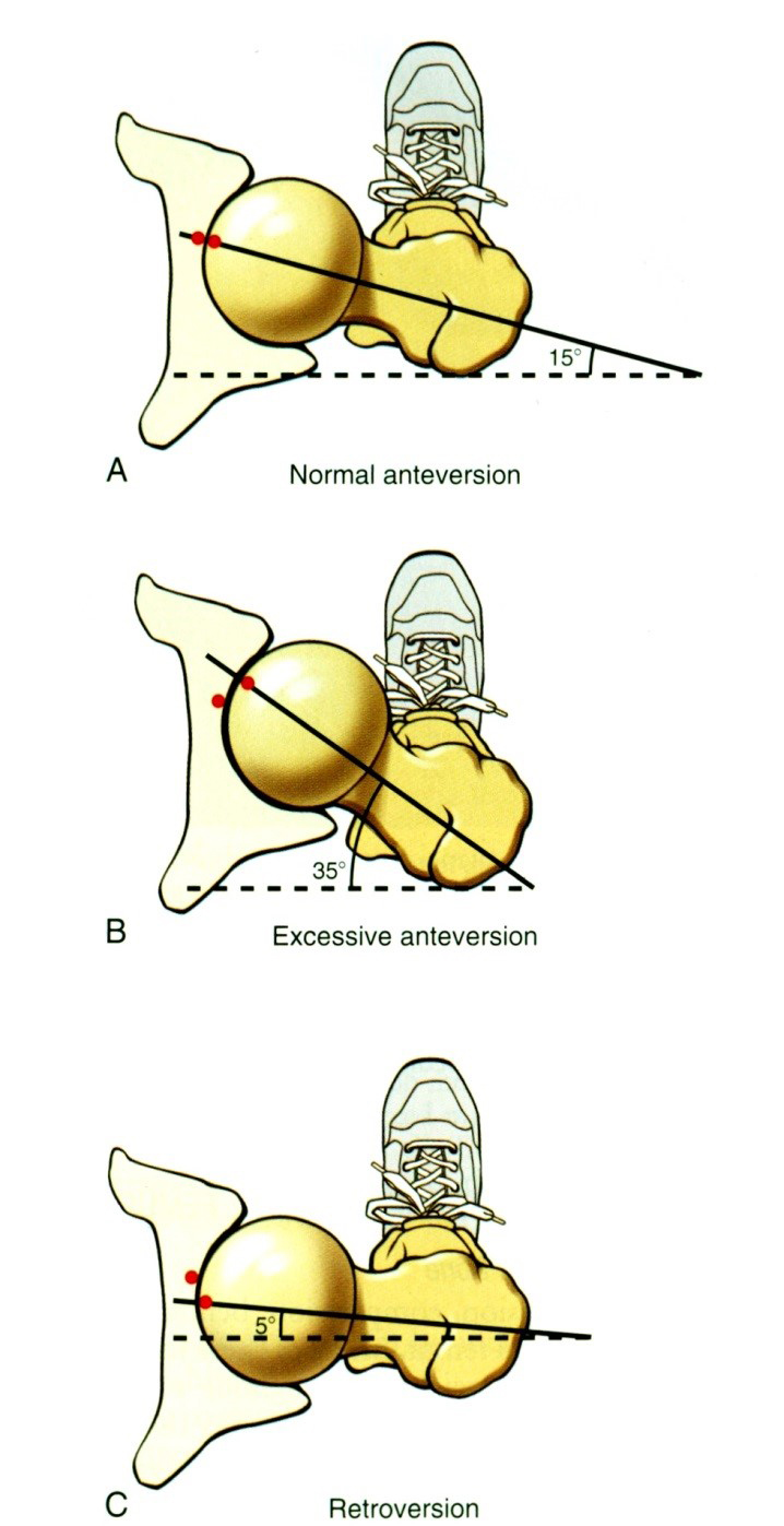 A A femur normál anteverziója B A femur fokozott anteverziója C A femur retroverziója 