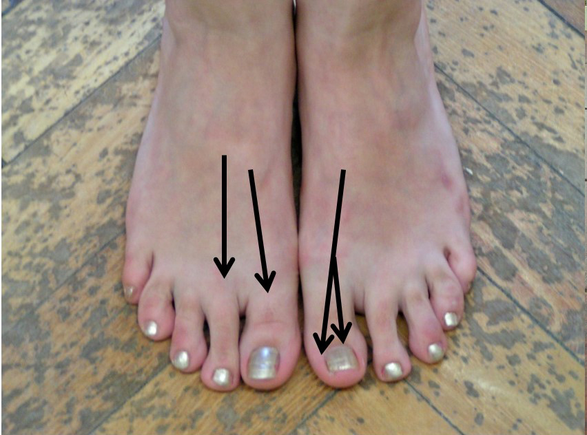 Az I-es és II-es metatarsus egymással kisebb, mint 15 fokos szöget zár be (jobb láb). Az I-es metatarsus és az öregujj proximális ujjpercének hossztengelye 20 foknál kisebb szöget zár be (bal láb).