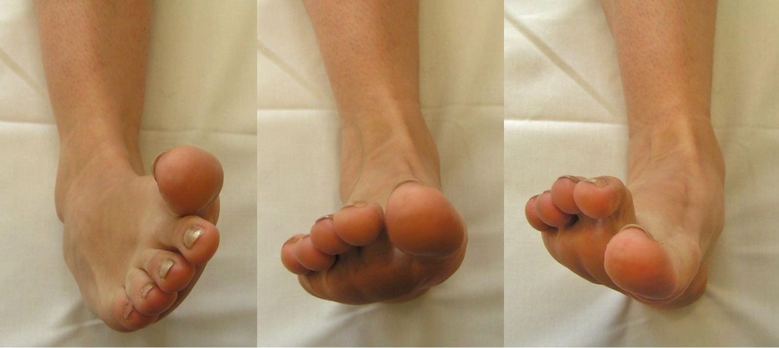 A láb szupinációja (1. kép) neutrális helyzete (2. kép) és pronációja (3. kép), fekvő helyzetben vizsgálva.
