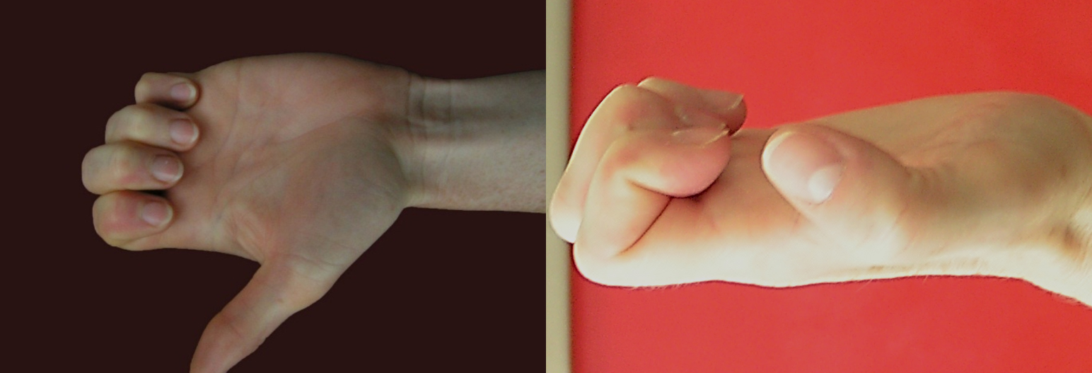 Gyors teszt a 2-5-ös ujjak DIP és PIP ízületek flexiós mozgásterjedelmének megítélésére.