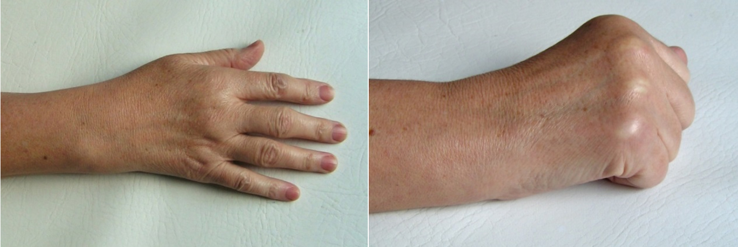 Kezdődő kézdeformitás rheumatoid arthritisben: a csuklóízület enyhe radiális deviációban, a II-III-as ujjak MCP ízülete kezdődő ulnaris deviációban van,  a csukló, az MCP és PIP ízületek duzzadtak. Az MCP ízületek duzzanata jól látszik az ökölbe zárt kéztartásban (a bőr feszülő, fényes)