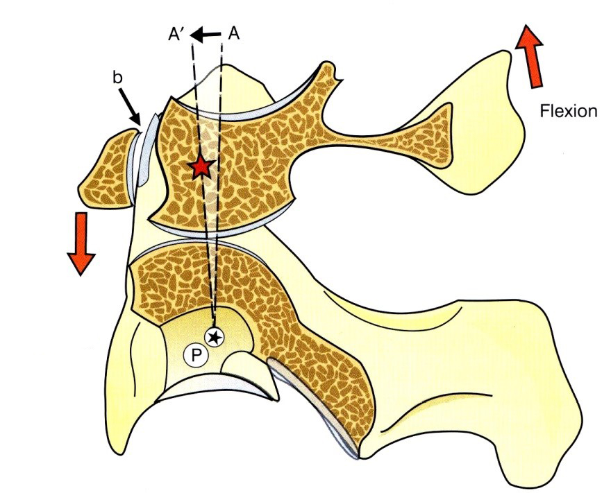 Az articulatio atlanto-axialis részei szagittális síkban és az ízfelszínek elmozdulása flexió során