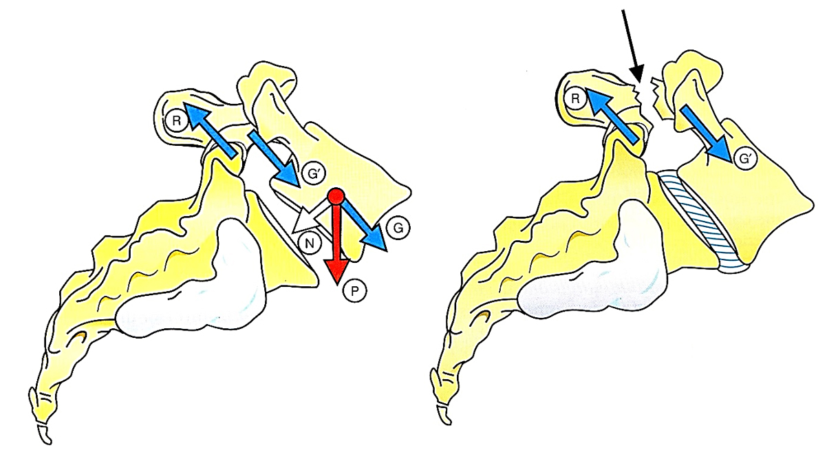  Spondylosis – az ízületi tok és a szalagok lazasága (1.kép) és spondilolisthesis (2.kép) a csigolyaív törése. Mindkét probléma a felső csigolyatest előrecsúszásával jár.  (Forrás: Kapandji: Physiology of the joints vol. III.) 