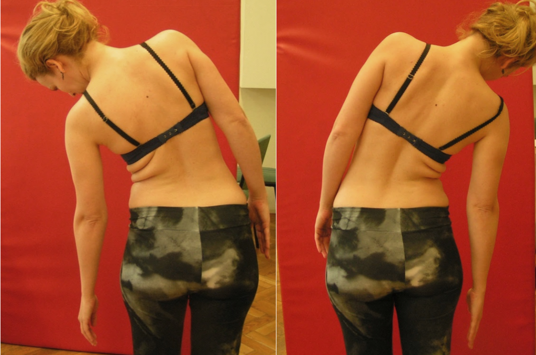 Laterál-flexió a lumbális és háti gerincszakaszon.  A mozgás a két oldalra kb. azonos mértékű, a gerinc vonalában törés nem látható.