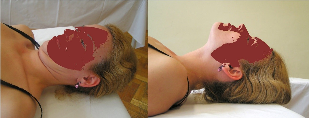 A felső nyaki szakasz aktív flexiója (1. kép) és extenziója (2. kép)