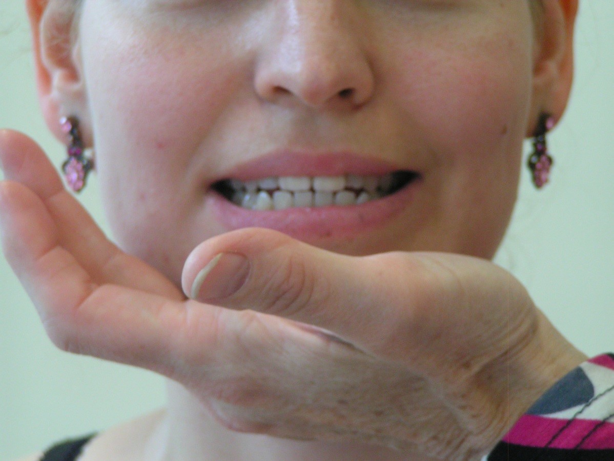 A szájnyitó izmok erejének vizsgálata (4-5-ös izomerő).  A vizsgáló elevációs irányú ellenállást ad az álkapocsra