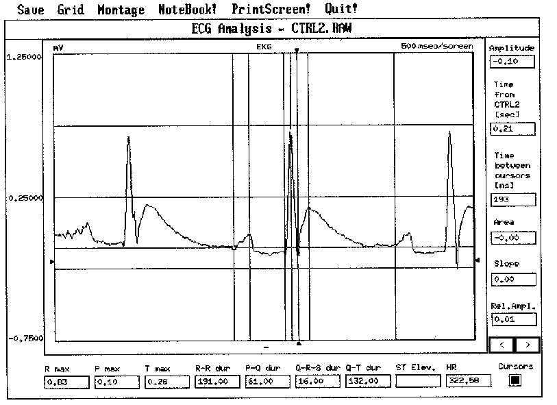 EKG jel a n. vagus ingerlése előtt