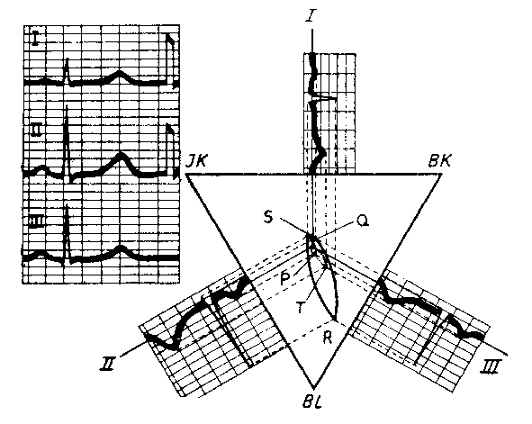 Az emberi szív EKG jelei az Einthoven-féle elvezetésekben