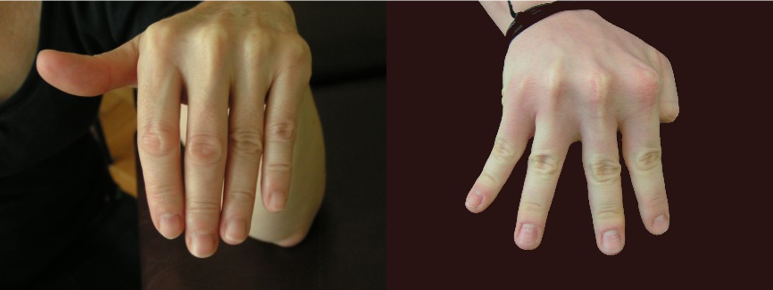 A MCP ízület collaterális szalagjainak stabilitási tesztje.  Stabil oldalszsalagok nem engedik a nyújtott ujjak nyitását flektált MCP ízület mellett (1. kép); az ujjak nyithatósága instabil szalagok esetén (2. kép)