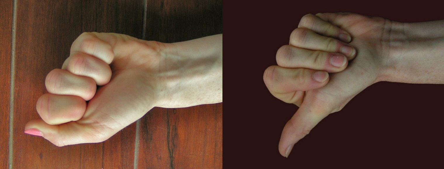 Gyors tesztek a 2-5-ös ujjak flexiós mozgásterjedelmének felmérésére.  Az ujjak összes ízületének hajlítása (1. kép), az MCP és PIP ízületek hajlítása (2. kép)