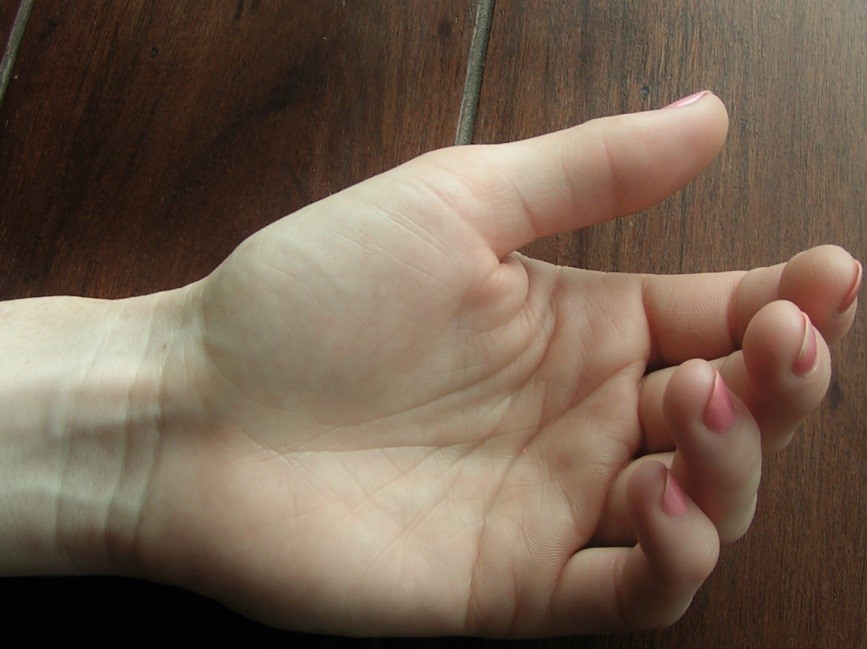 A hüvelykujj irányultsága a tenyérhez viszonyítva. A hüvelykujj a tenyér síkja (frontális) és a szagittális sík közötti ferde síkban áll.