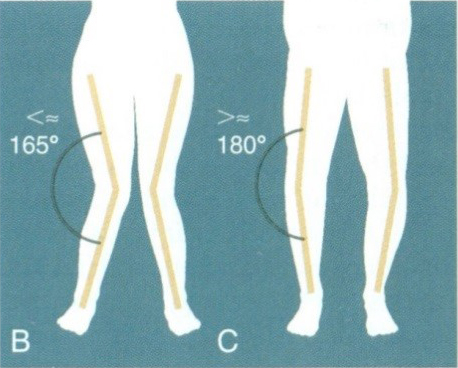 A térdízület patológiás tengelyeltérései  B Genu valgum  C Genu varum