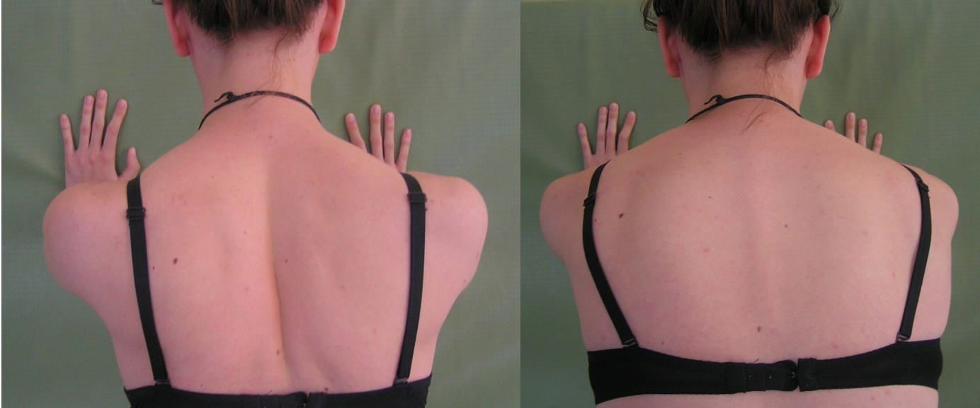 A m. serratus anterior funkcionális vizsgálata. 
